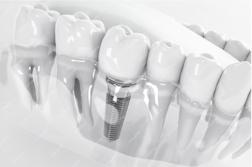 unveiling-the-allure-of-dental-implants-5-key-reasons-behind-their-popularity